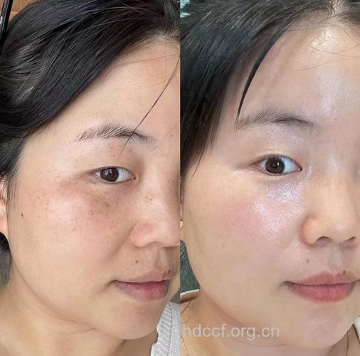 5大神奇祛斑术 夏季肌肤超白皙