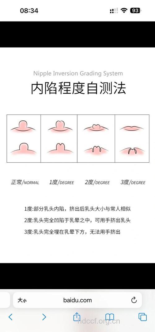 如何矫正乳头凹陷问题