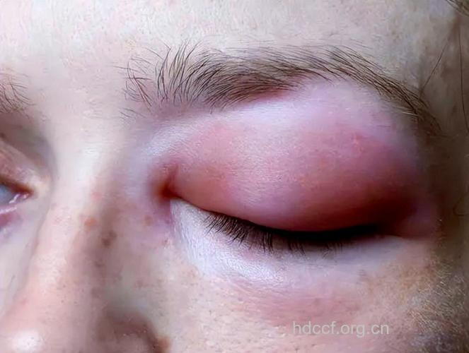 面色泛黄或是尿毒症 盘点尿毒症6种症状