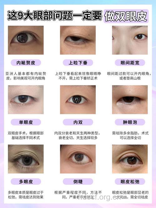 六种割双眼皮方案 哪种适合你