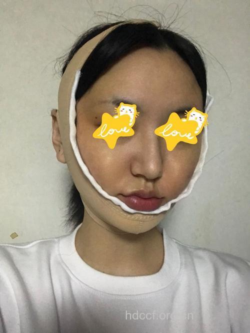 磨骨瘦脸术后如何消肿
