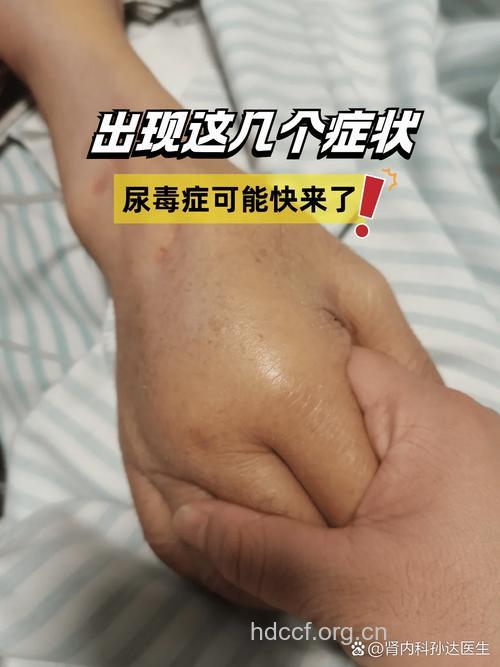 晚期尿毒症有哪些症状