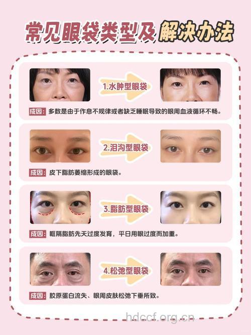 祛眼袋方法 吸脂术去眼袋怎么样