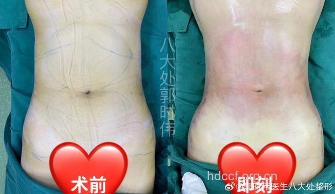 腰腹部吸脂术前准备有哪些