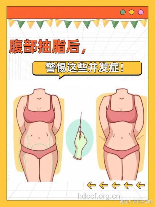 腹部吸脂警惕4大风险