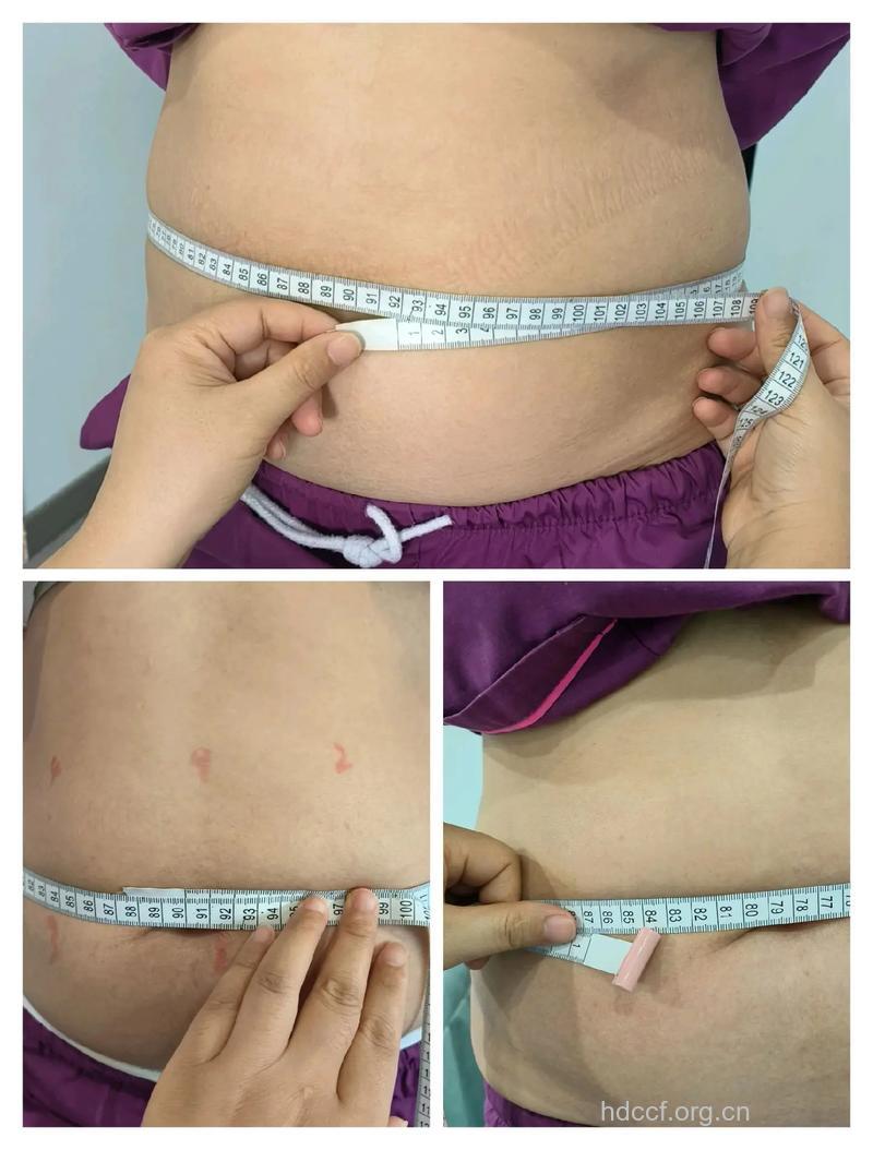 5种最棒腹部整形术对比
