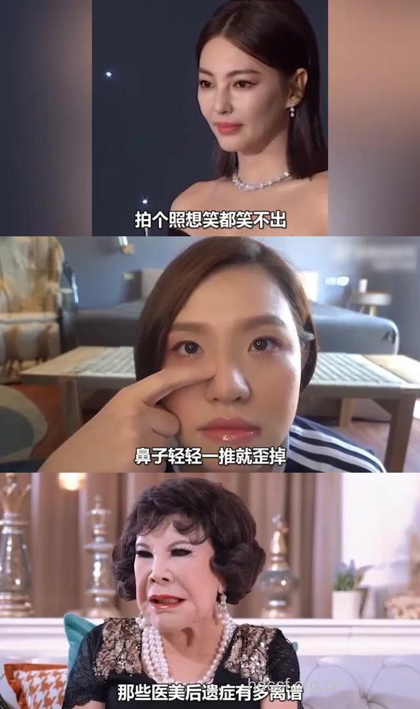 没有玻尿酸 明星怎么活