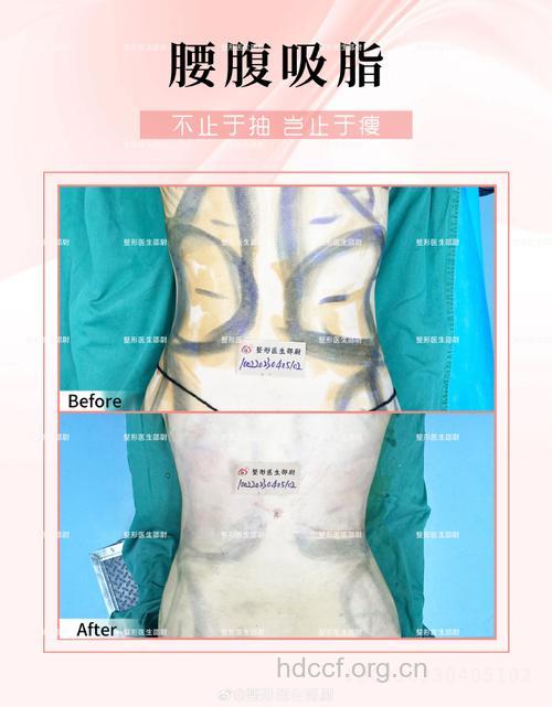 局部吸脂手术的三大误区