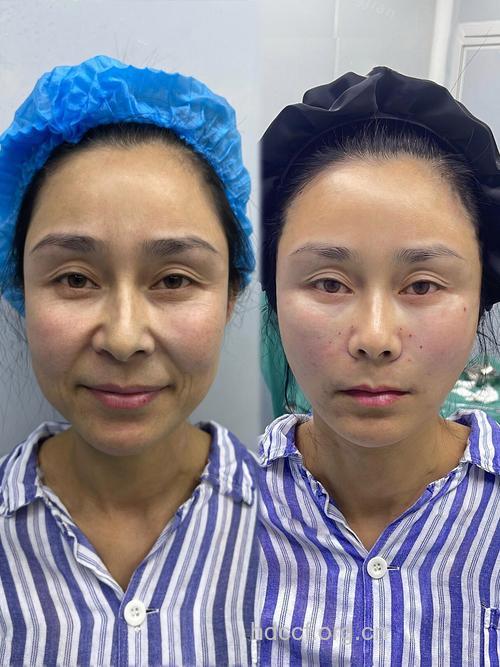 三大丰面颊的面部整形手术