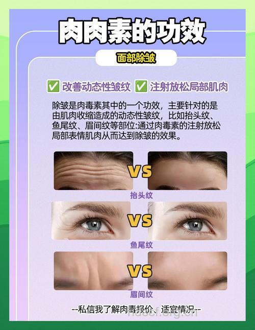 肉毒素除皱的6大副作用