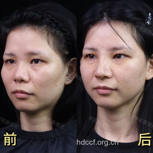 5个方面解释膨体隆鼻整形的效果