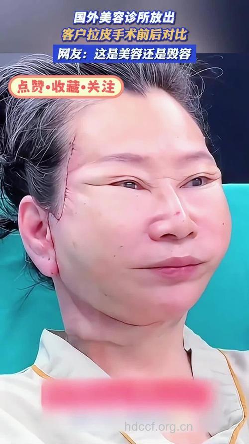 除皱拉皮手术效果怎么样？