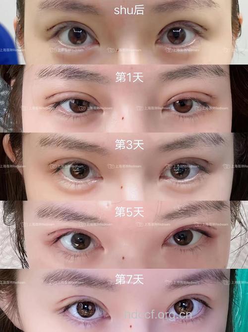 双眼皮手术的7大后遗症