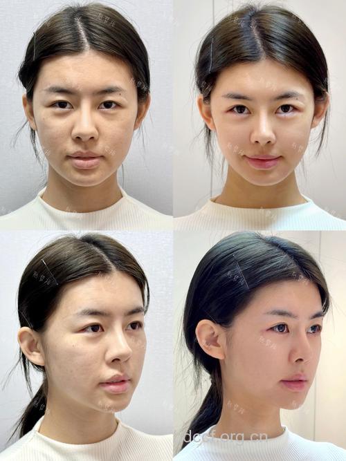 4种最受关注的面部微整形