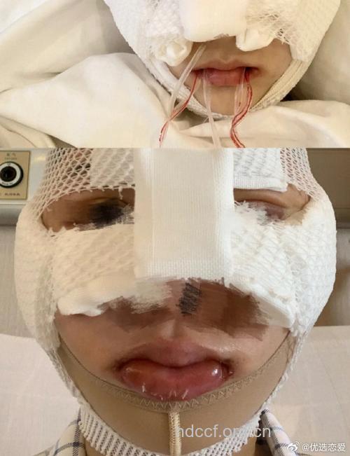 颧骨整形术后如何护理