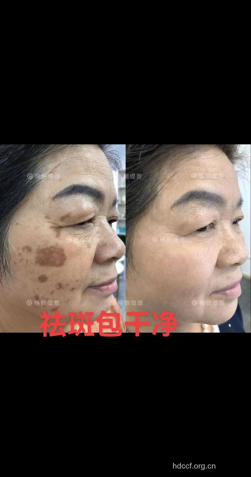 整形手术的4大祛斑法