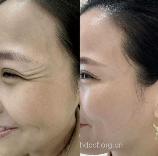 射频除皱有什么特点