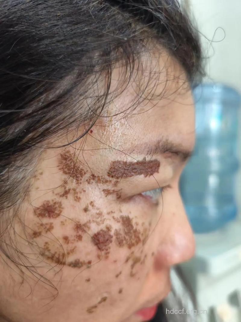 三种激光手术 祛斑不留痕迹！