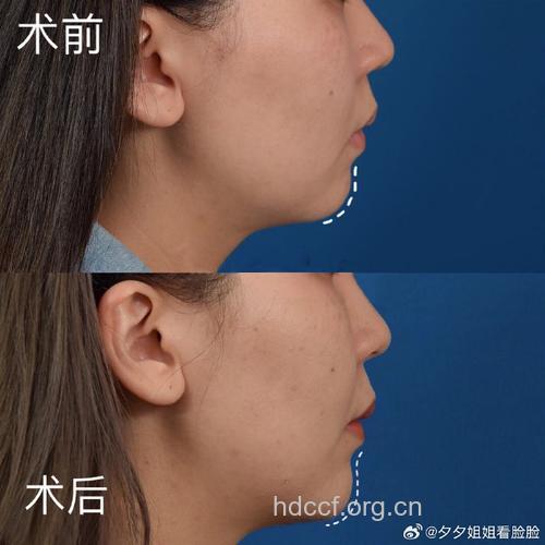 改变脸型要注意垫下巴的后遗症