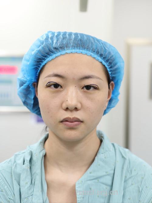 双眼皮手术能让你的眼睛更有神