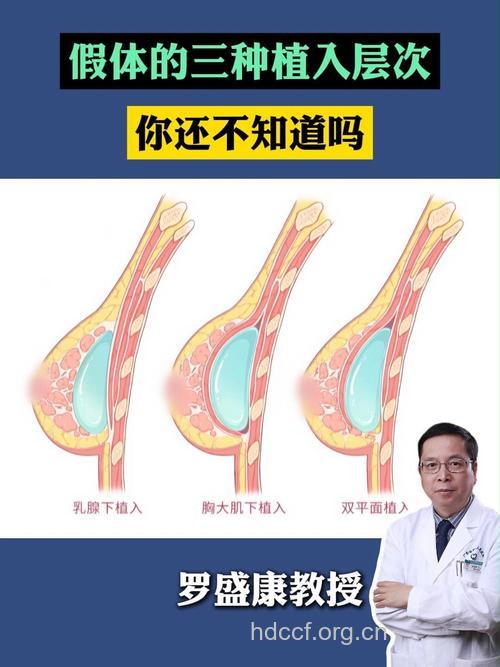 什么是乳房假体植入法