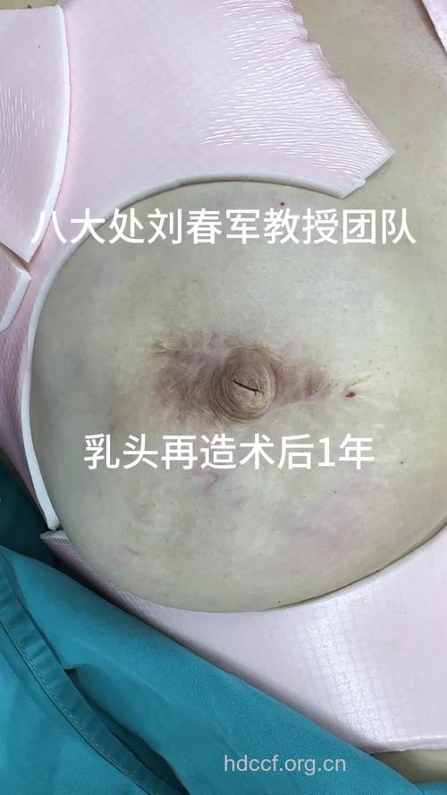 乳癌病人可选的乳房再造术