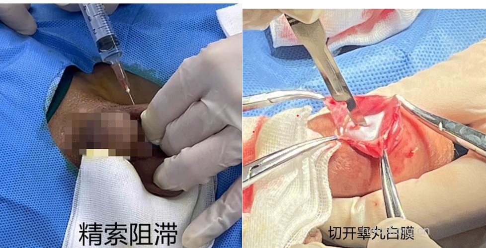 男人哪些情况必须生殖整形?