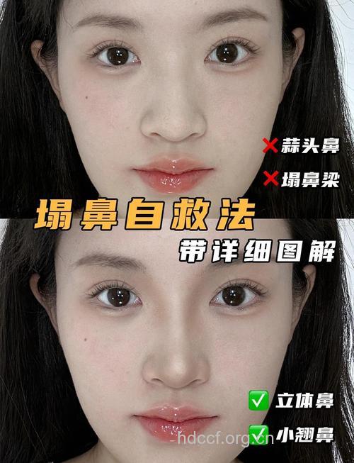 塌鼻子怎么办 整形教你鼻子坚挺