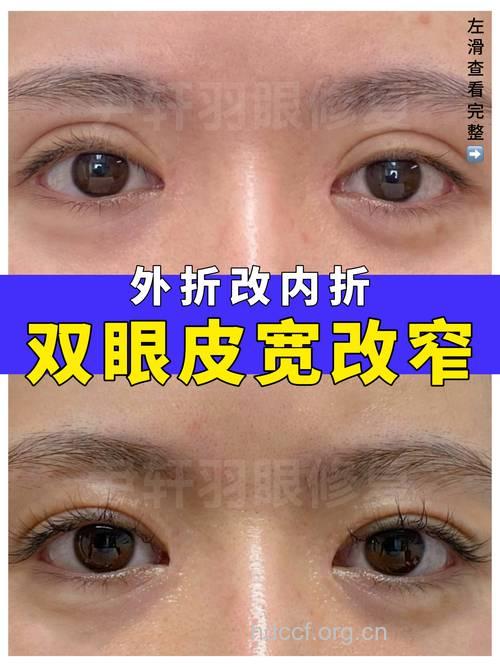 双眼皮做宽些好还是窄些好?