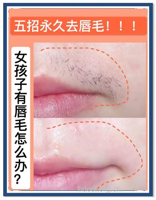 女性唇毛怎么办?如何解决