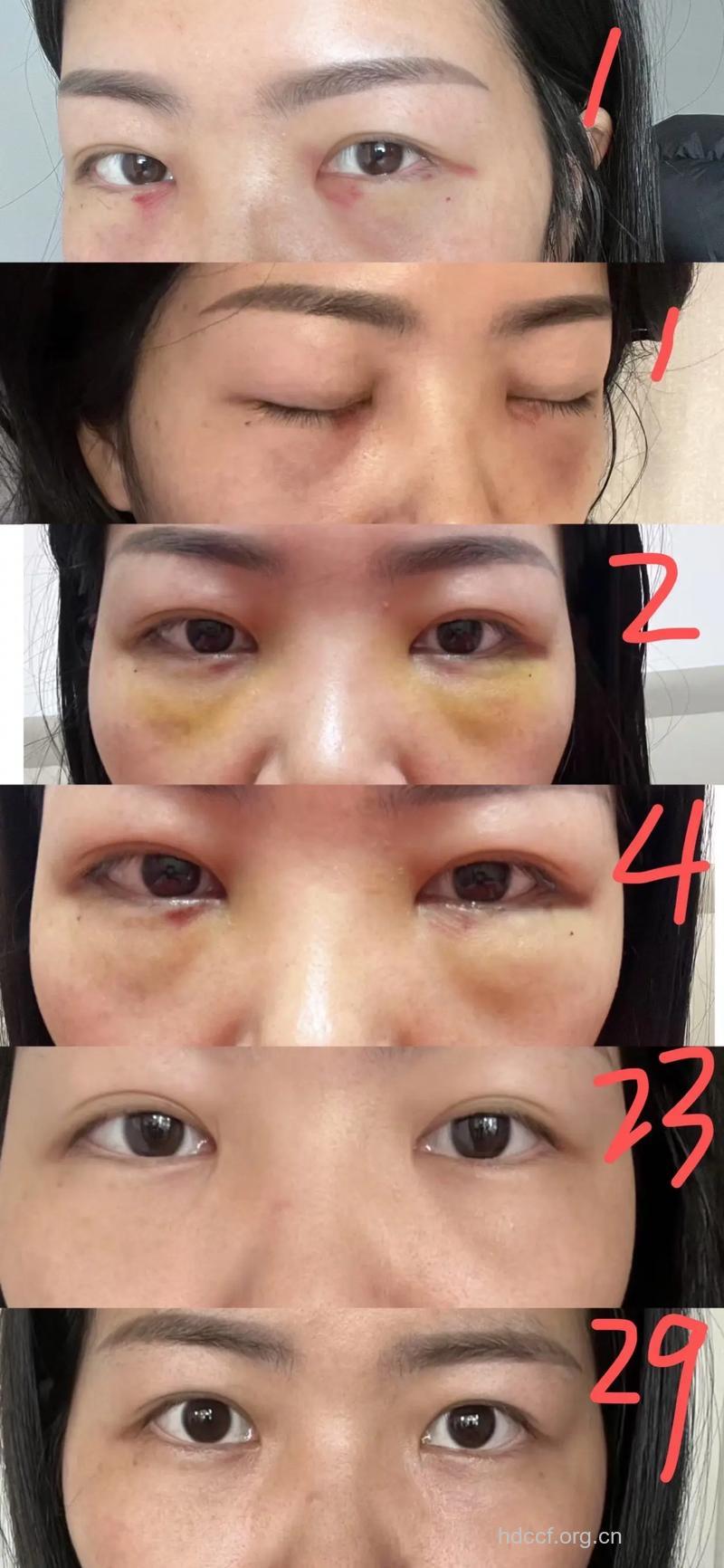 祛除眼袋的手术