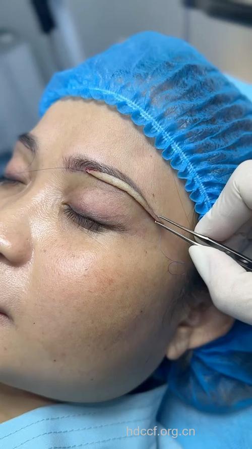必知的眉再造术