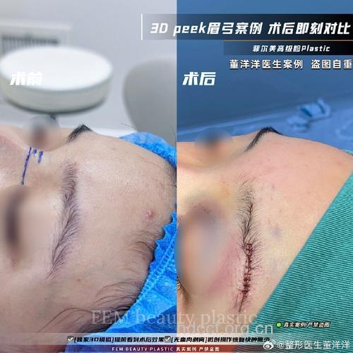 力荐三种隆眉弓的整形手术