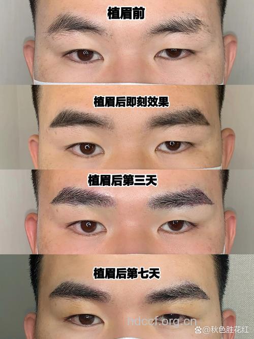 眉毛移植的特点是什么