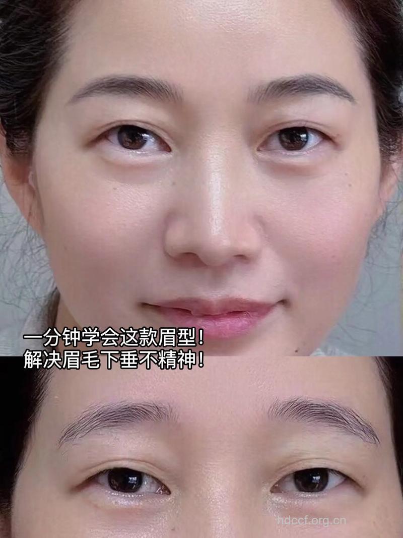 眉毛下垂应该如何矫正?