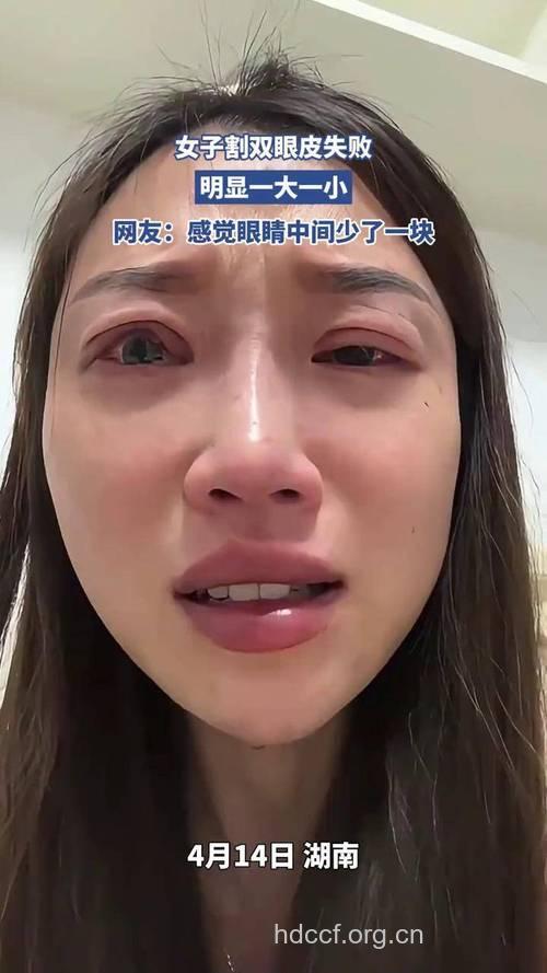 双眼皮术失败的九大表现