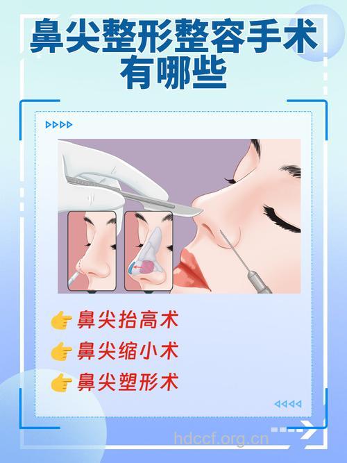 鼻尖的整形方法有哪些