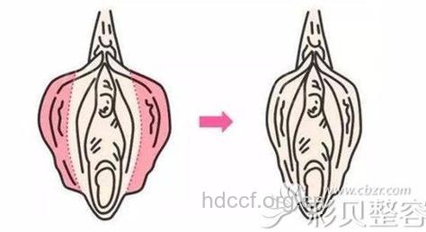 阴蒂肥大的术前术后