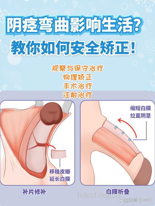 阴茎弯曲矫正