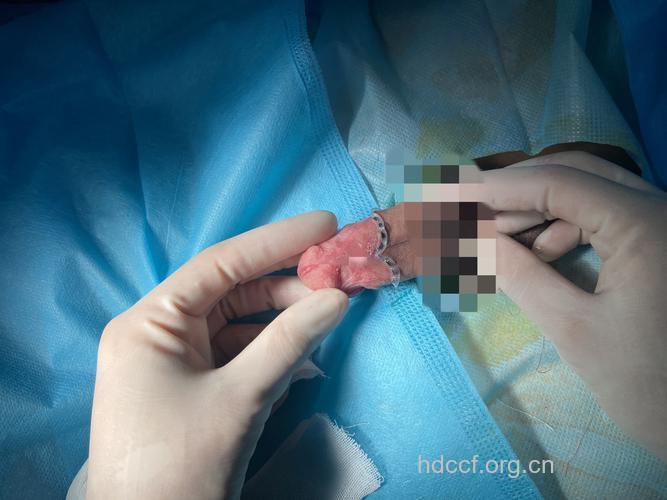 什么是包皮环切术