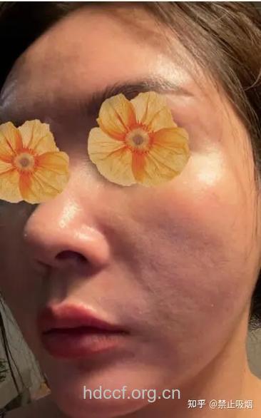 面部吸脂失败的四大表现
