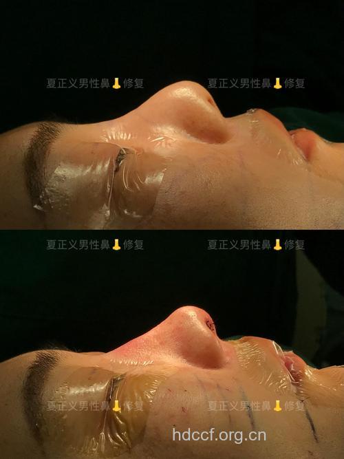 男性假体隆鼻的设计