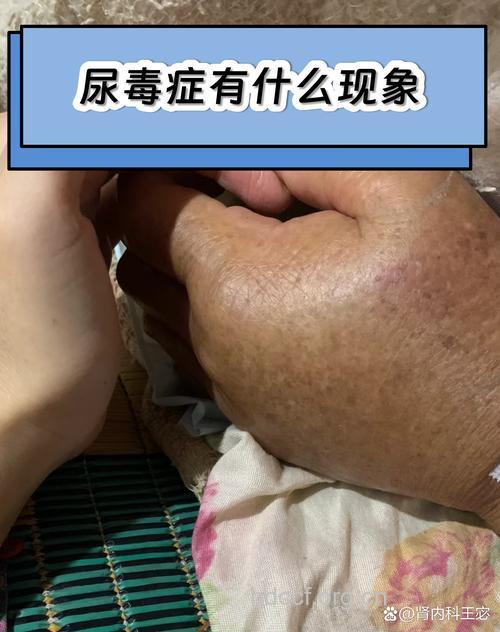 夜晚尿毒针有什么症状呢