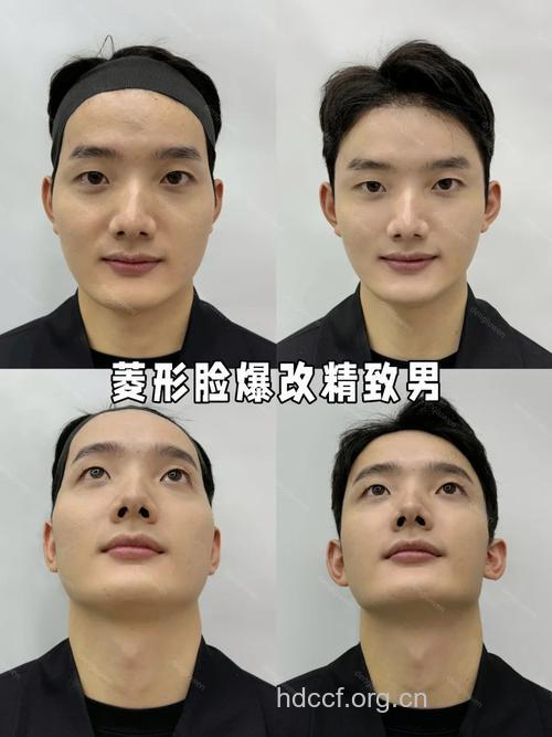 男人有哪些面部整形方法