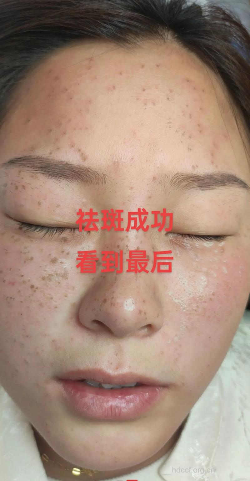 激光祛除晒斑的效果怎么样