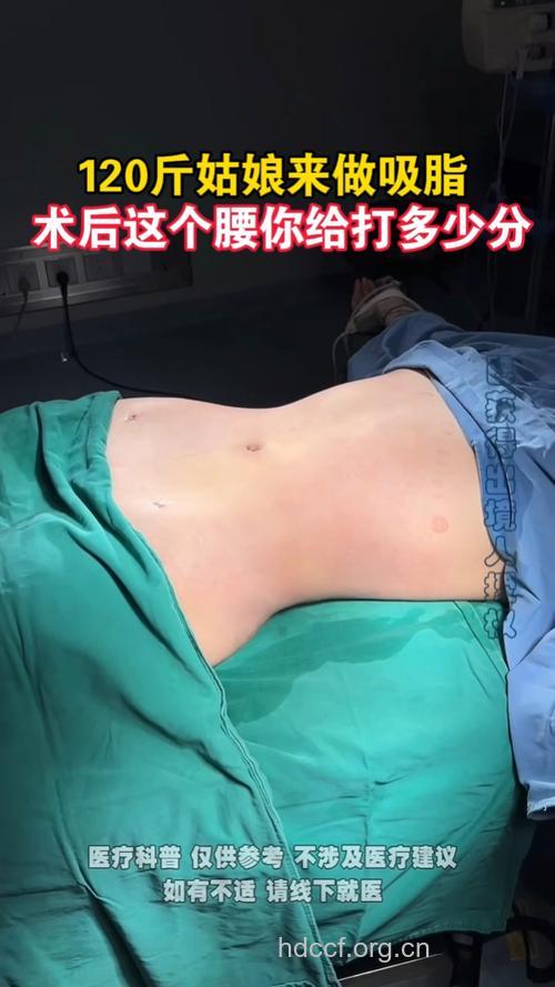 哪些人可以做腰部吸脂