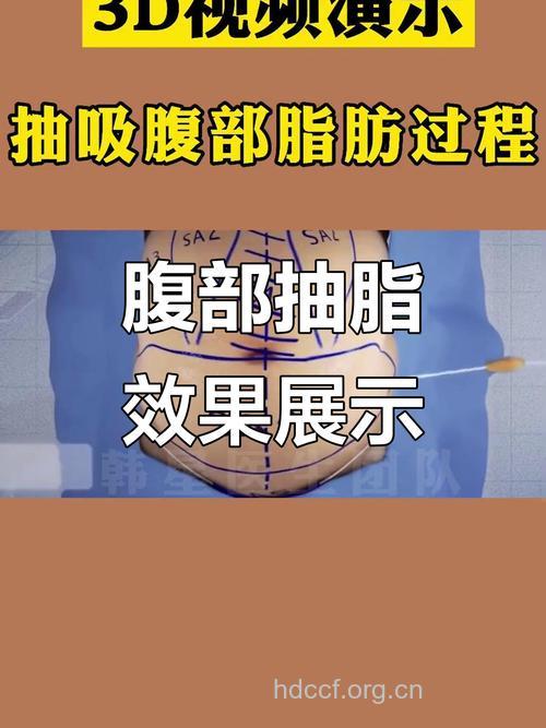腰部吸脂减肥的原理