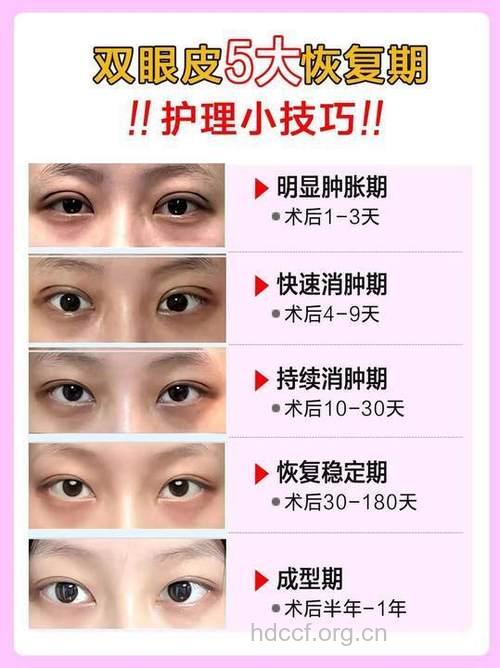 双眼皮术后有哪些细节问题