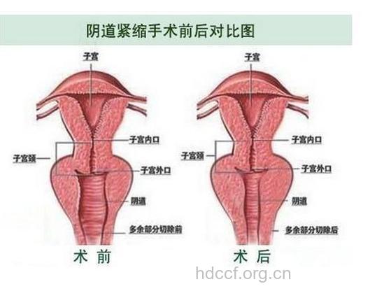 女性怎么进行阴道紧缩手术