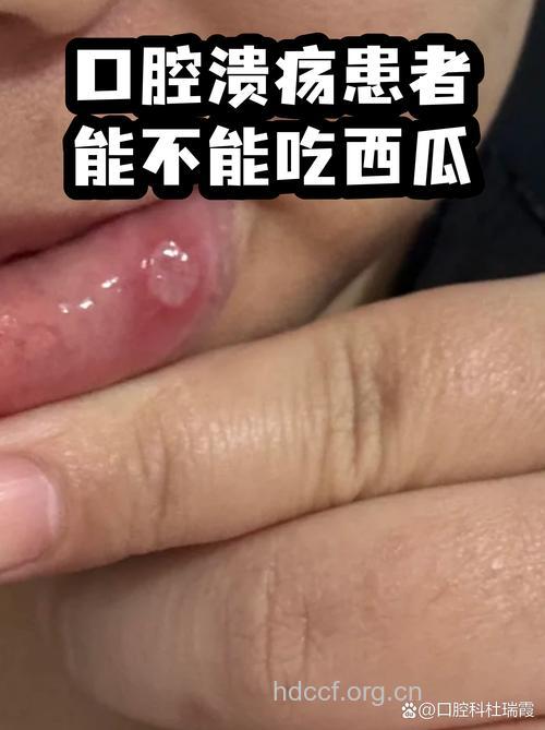 口腔溃疡病人能不能吃西瓜